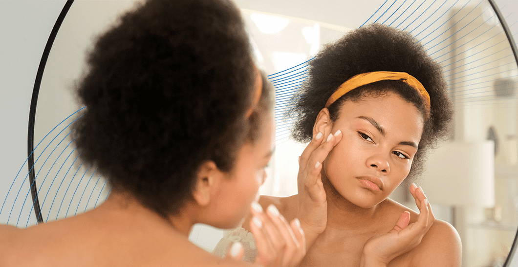 Melasma